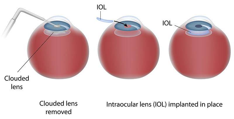 Chart Illustrating the Cataract Surgery Process