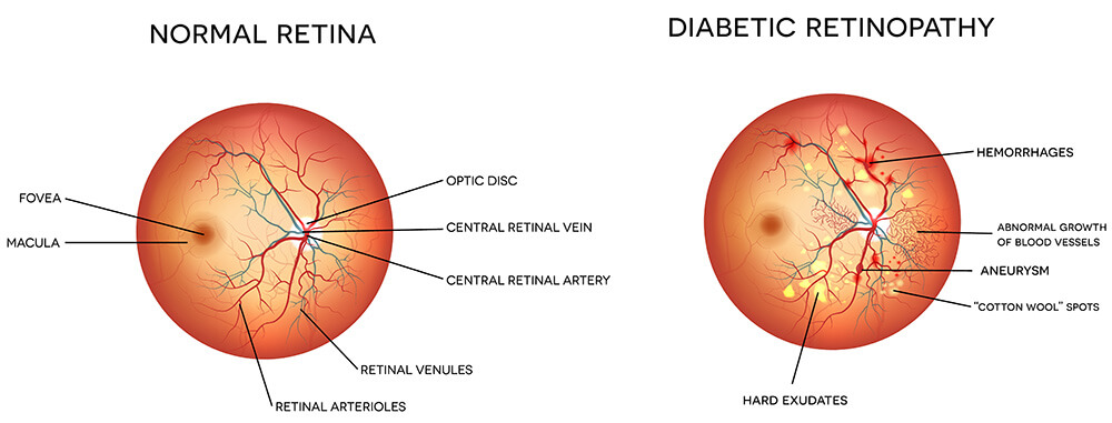 Chart Illustrating a Normal Retina vs One Experiencing Diabetic Retinopathy