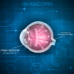 Glaucoma Diagram